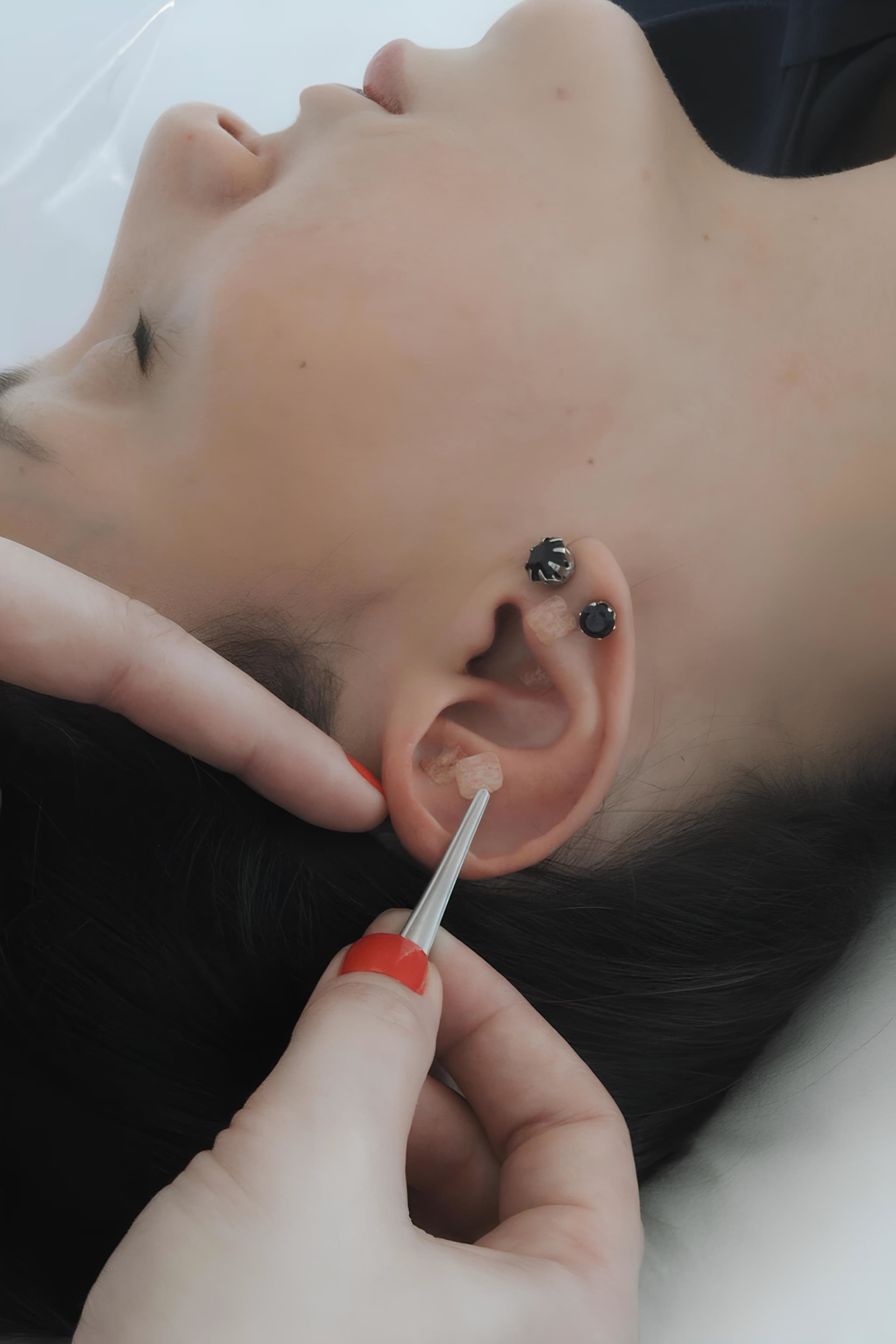 Auriculoterapia